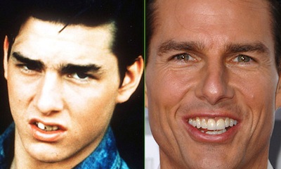 Tom-Cruise-teeth-before-after-cosmetic-dentistry