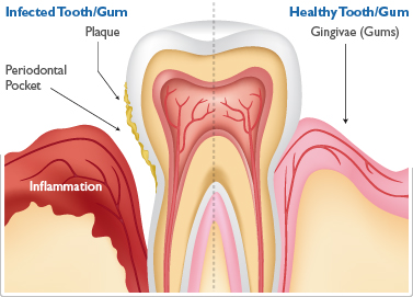 periodontal-gum-disease