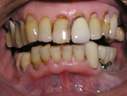 TMJ-Dentist-Los-Angeles-before